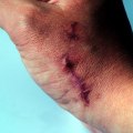 What percentage of personal injury claims are successful?