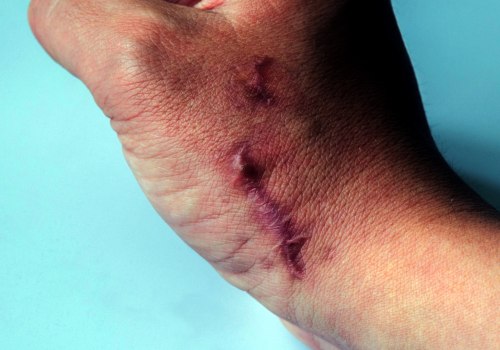 What percentage of personal injury claims are successful?