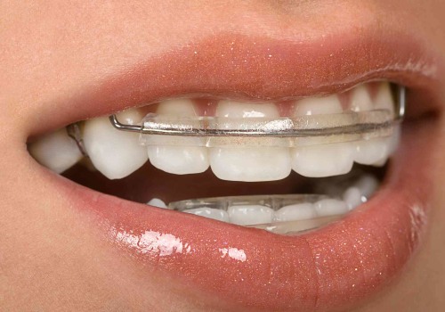 Do you get a retainer fee back?